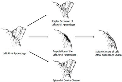 Left atrial appendage exclusion in atrial fibrillation